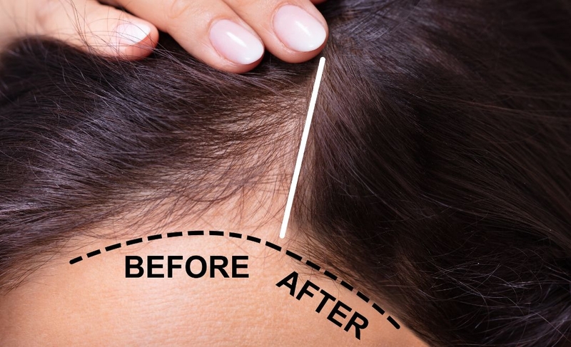Khám phá nguyên nhân và giải pháp trị rụng tóc